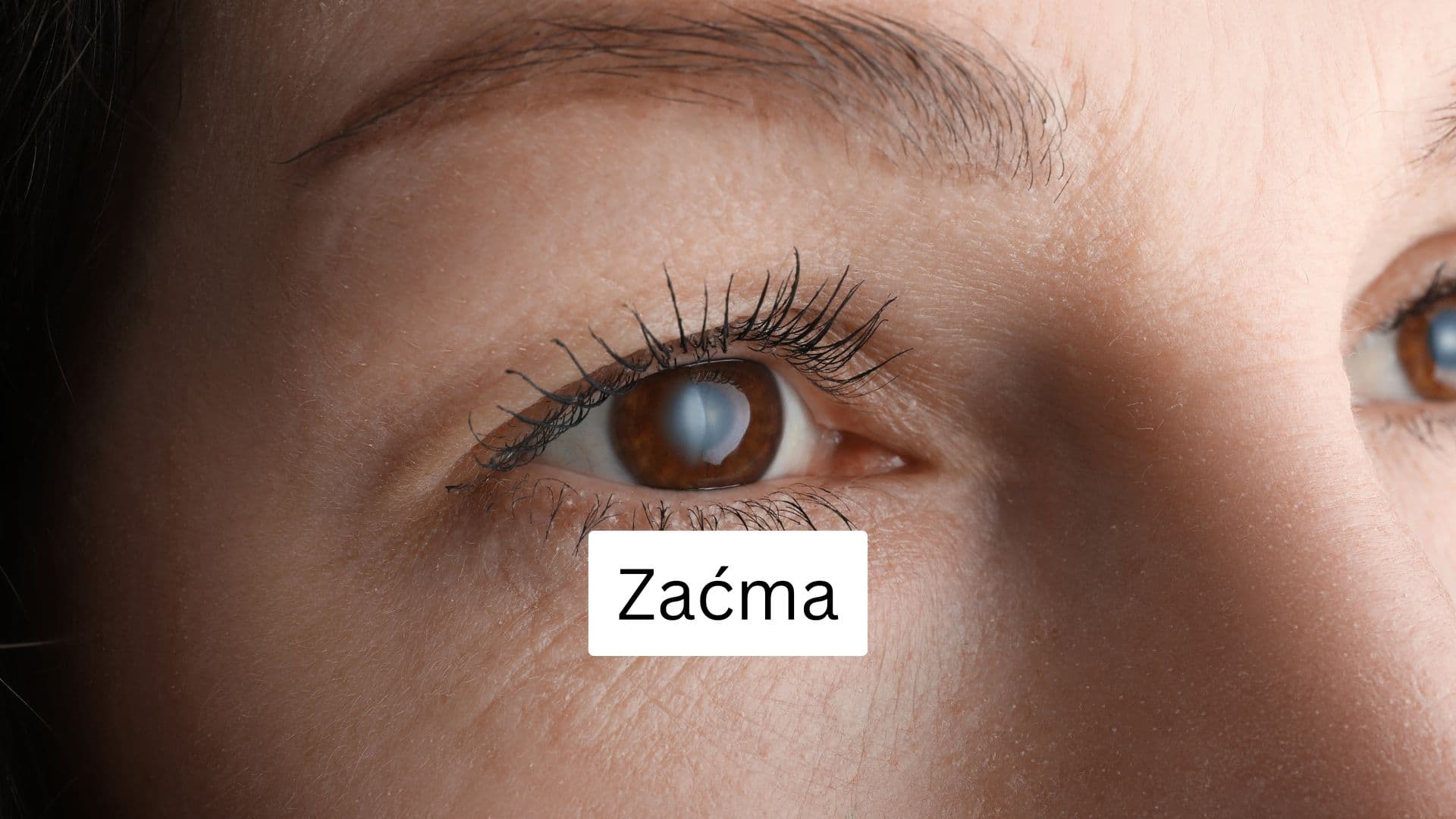 Co to jest zaćma?